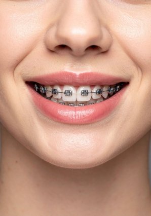 Dental Implants in Calamba