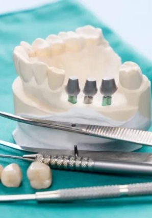 Dental Implants in Calamba